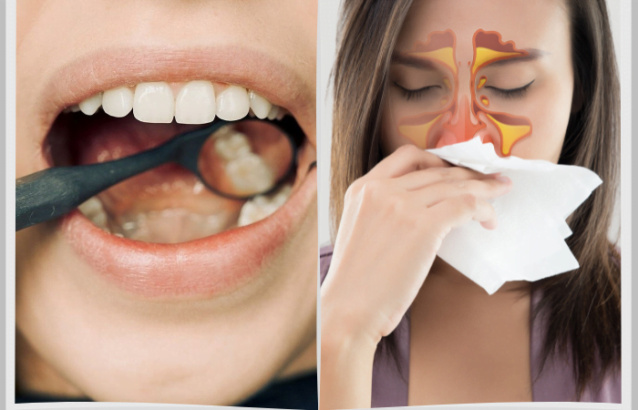 wisdom teeth removal & sinus problem